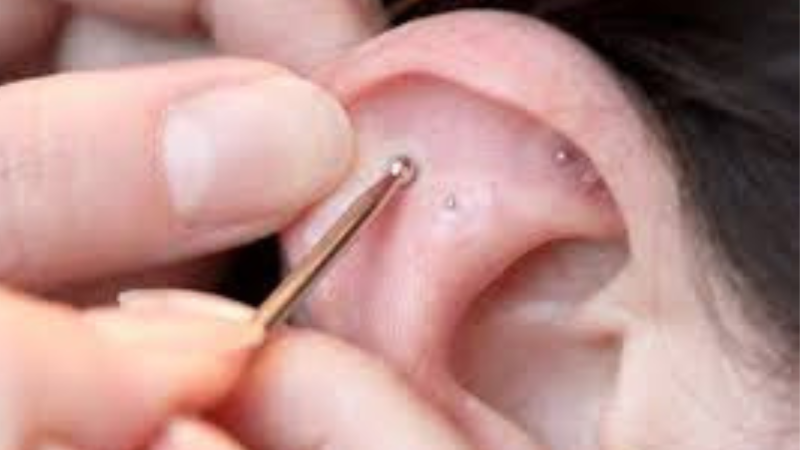 Invista no Caminho para a Saúde Holística com a Auriculoterapia